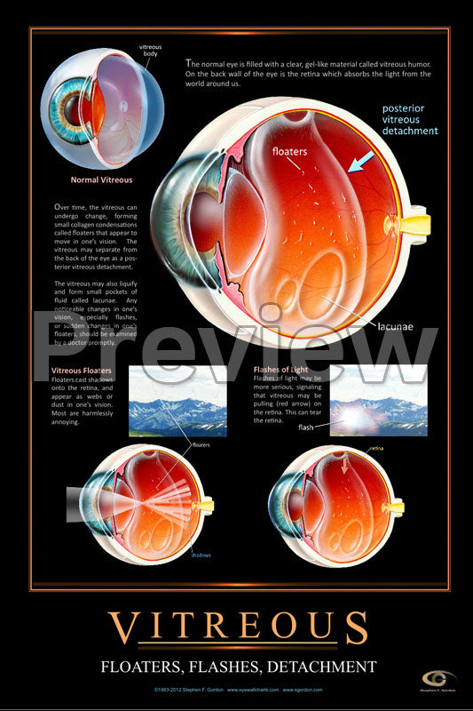 Vitreous, Flashers & Floaters Poster – Eye Flip Charts by Stephen F. Gordon
