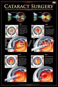 Cataract Surgery Poster